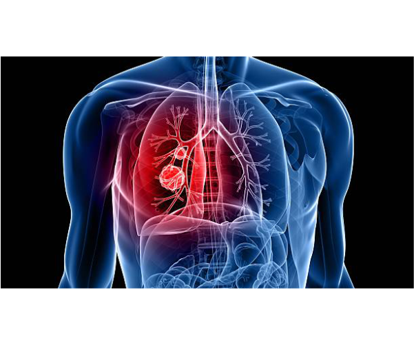 Tư vấn điều trị ung thư phổi